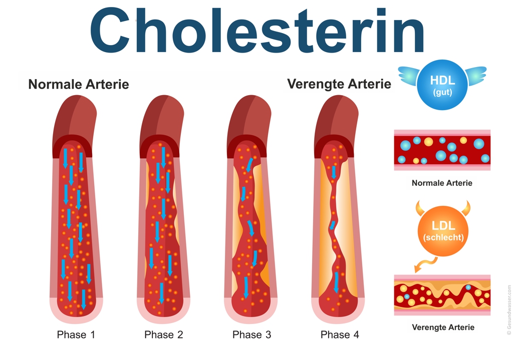 Cholesterin in der Arterie